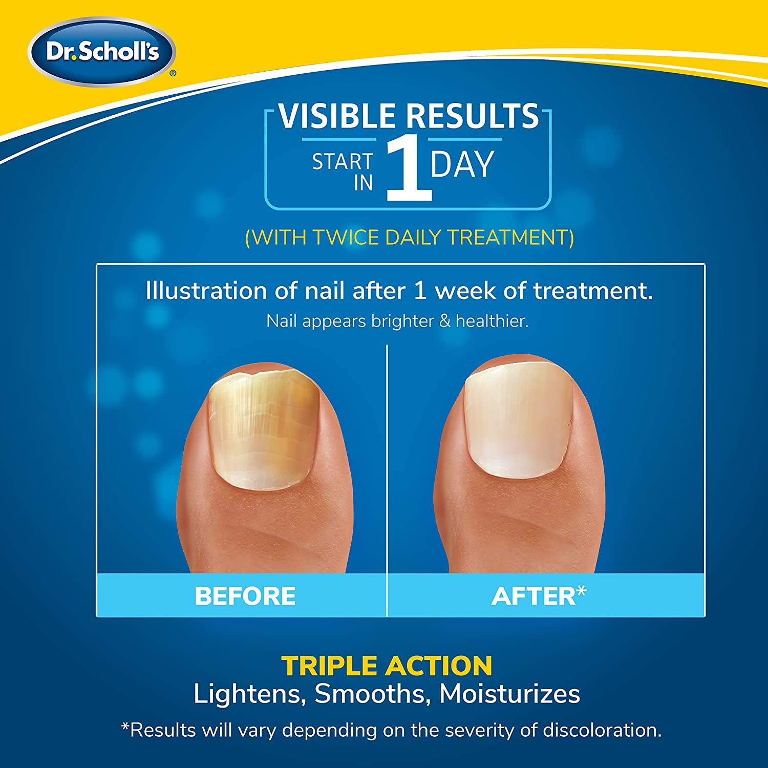 Does Led Light Kill Nail Fungus Dr. Scholl's Fungal Nail Revitalizer LED Light-Activated Therapy Erase